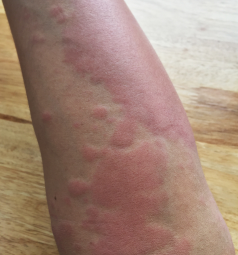 Hives – Skin & Laser Center of NJ Hives – Skin & Laser Center of NJ